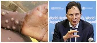 OMS: médico diz que varíola dos macacos pode ter se espalhado por sexo em festas LGBT